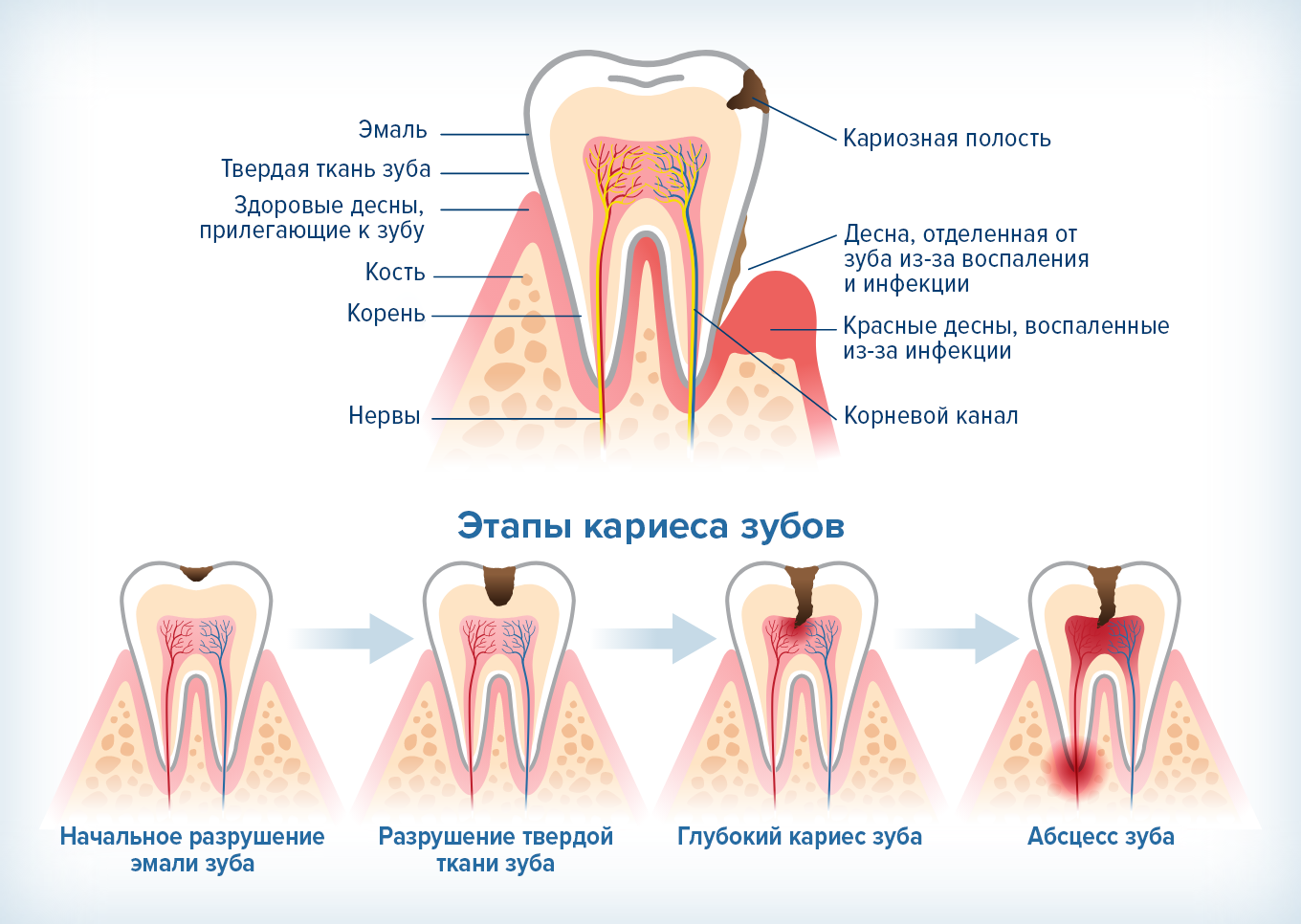 инфографика, показывающая развитие кариеса от раннего кариеса эмали зуба до абсцесса зуба.